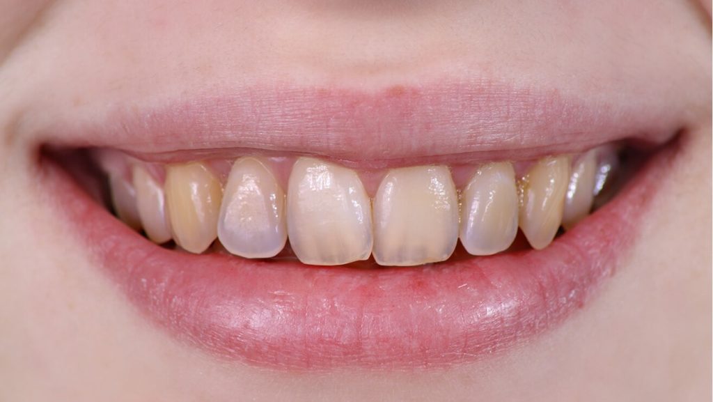 شیشه ای شدن دندان به علت فرسایش مینای دندان