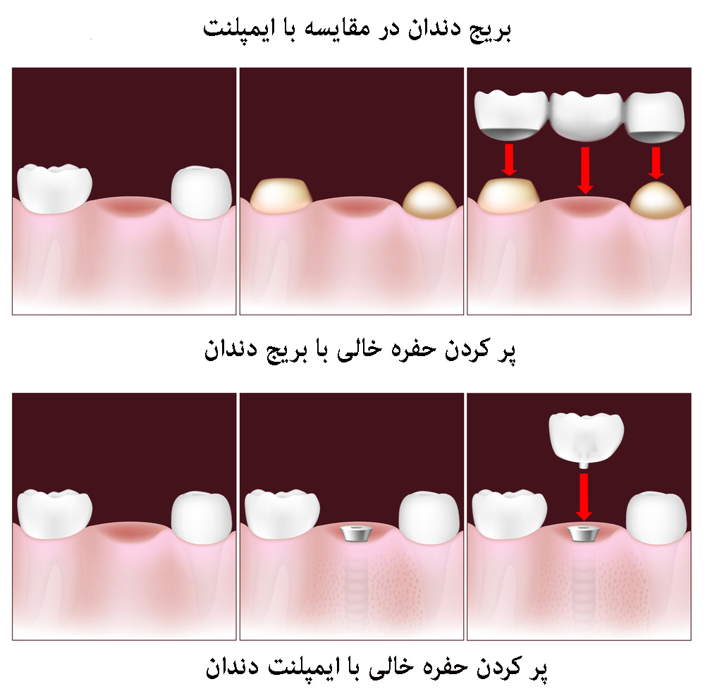 بریج دندان در مقایسه با ایمپلنت