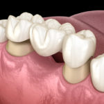 پل یا بریج دندان
