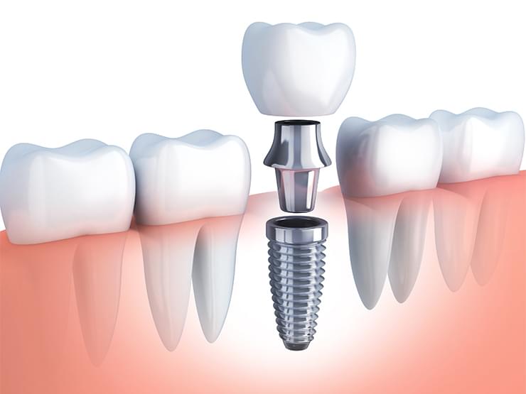 اجزای ایمپلنت دندان