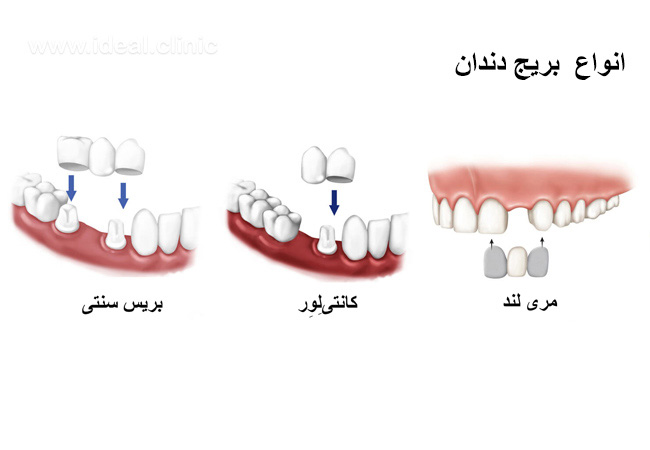 انواع بریج دندان