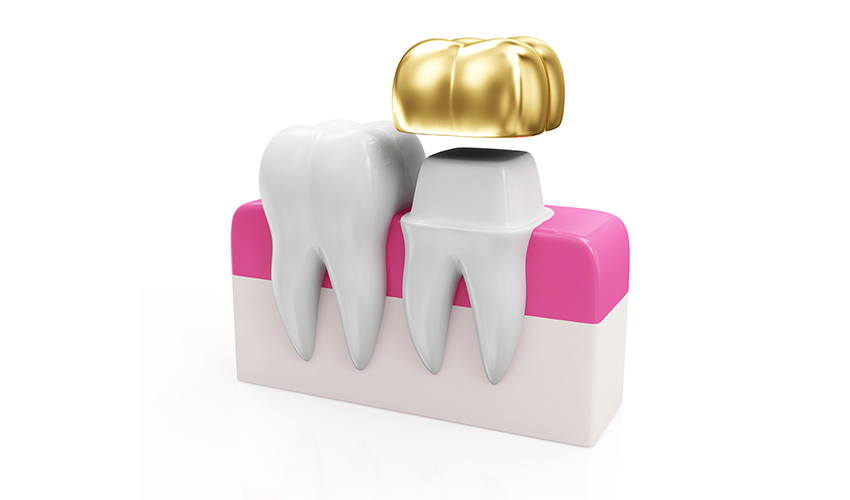 قاب دندان طلا