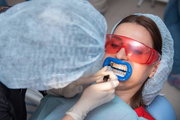 بلیچینگ در دندانپزشکی