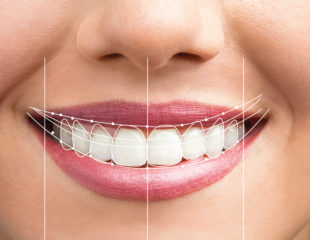 اصلاح طرح لبخند