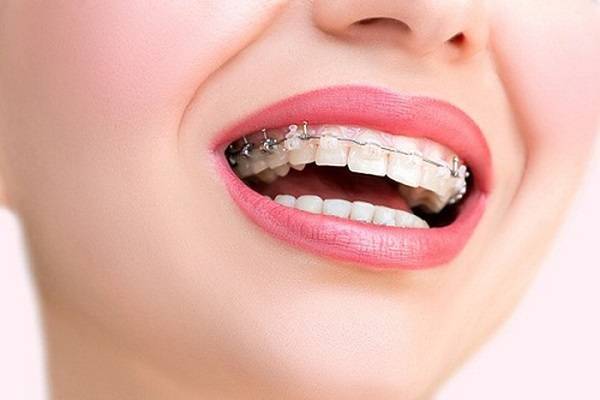 ارتودنسی بهترین روش اصلاح طرح لبخند