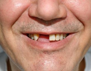 روش های جایگزین دندان از دست رفته