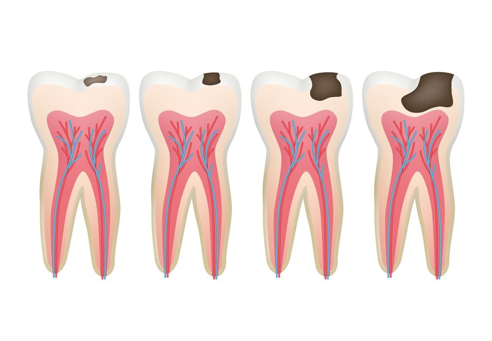 سطوح مختلف پوسیدگی دندان