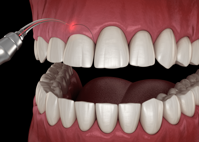 درمان لبخند لثه ای با لیزر