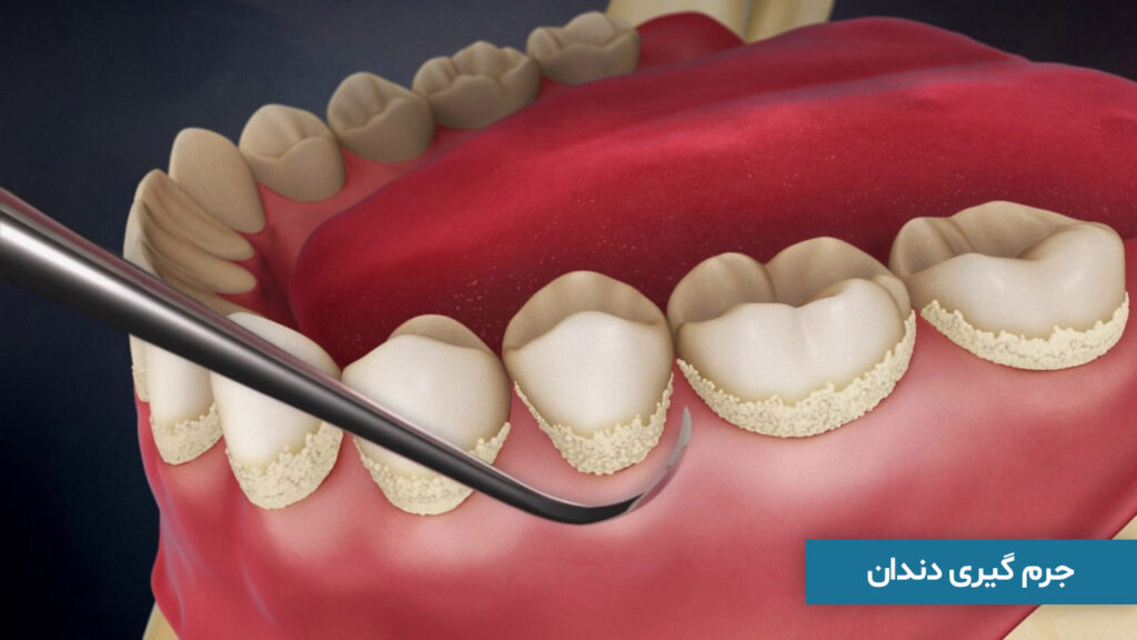 جرم گیری دندان