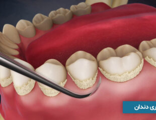جرم گیری دندان