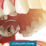 پوسیدگی دندان