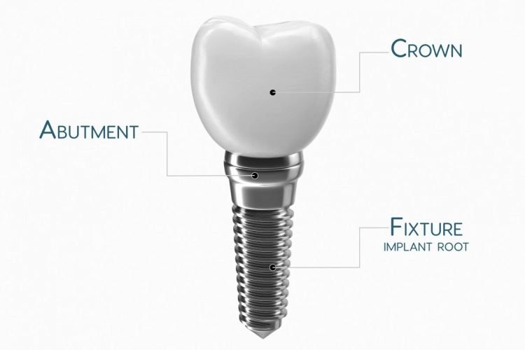 اجزای ایمپلنت دندان