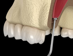 لیفت سینوس قبل از ایمپلنت دندان