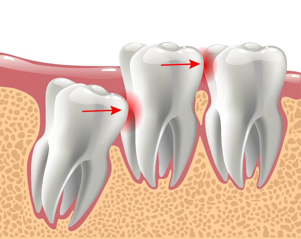 آسیب دندان عقل به دندان های مجاور