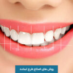 اصلاح طرح لبخند