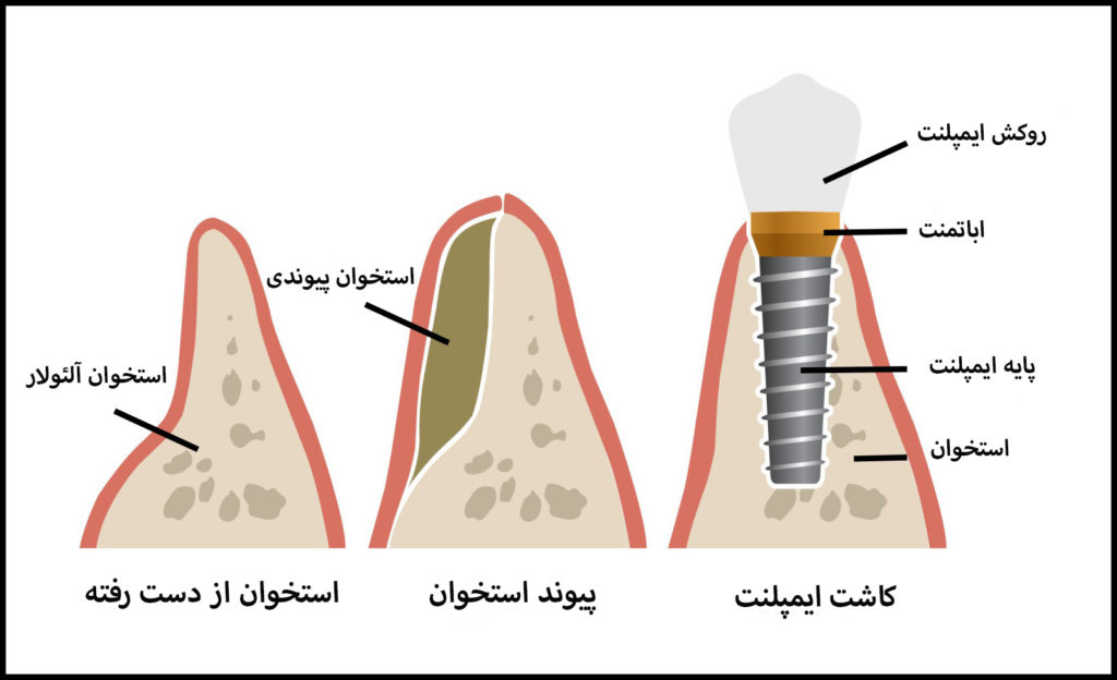 مراحل کاشت ایمپلنت با پیوند استخوان