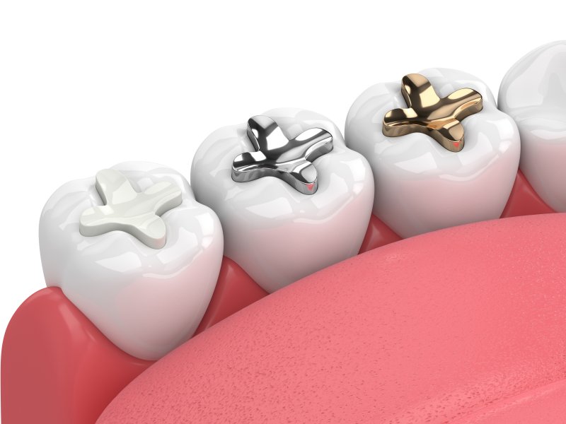 انواع مواد پر کننده دندان