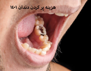 هزینه پر کردن دندان