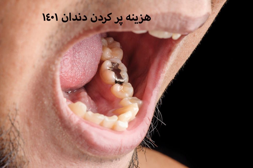 هزینه پر کردن دندان