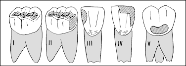 ترمیم دندان یک سطحی دو سطحی سه سطحی