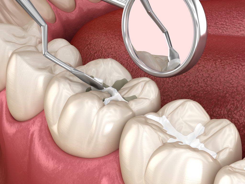 فیشور سیلانت یا شیار پوش برای پیشگیری از پوسیدگی دندان کودکان