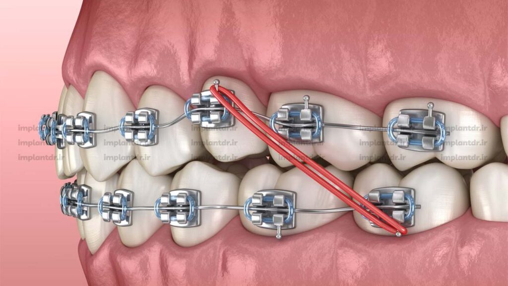 ارتودنسی دیمون