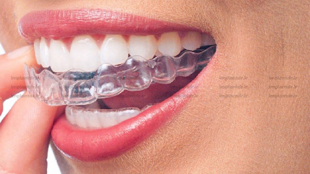 ارتودنسی نامرئی