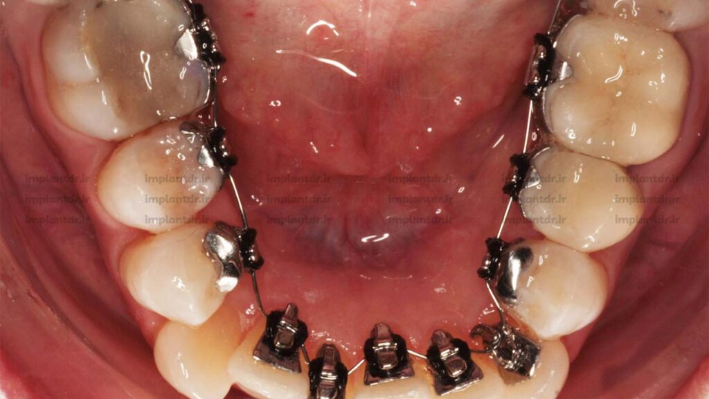 ارتودنسی پشت دندانی