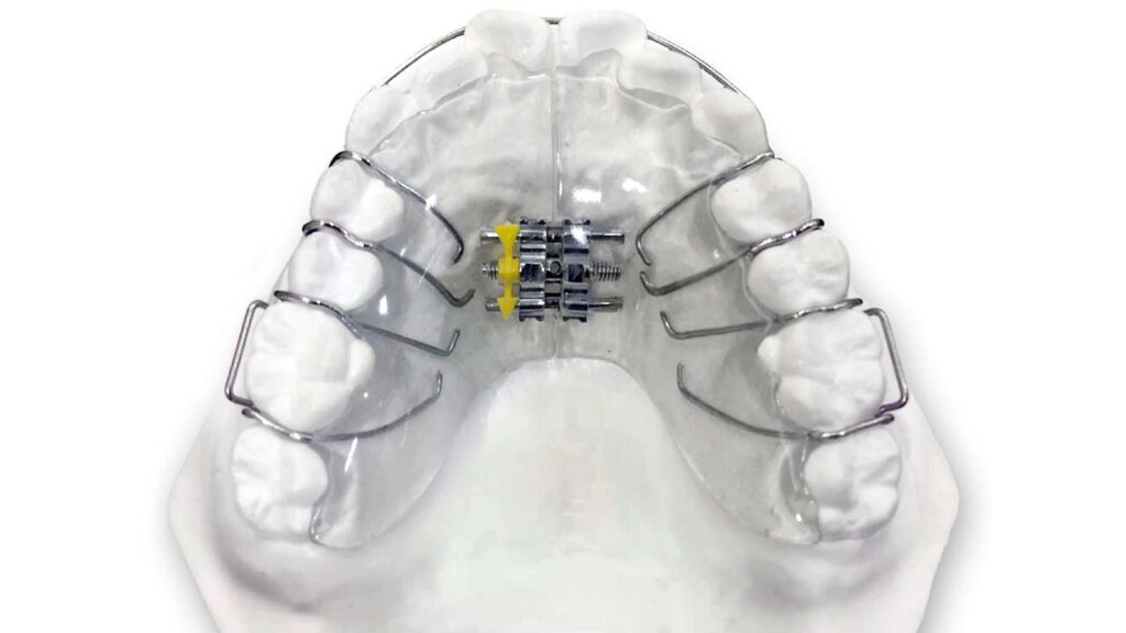 پلاک متحرک با فنر زد(Z)