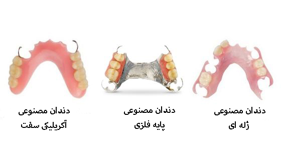 مقایسه دندان مصنوعی ژاله و پایه فلزی و آکریلیکی