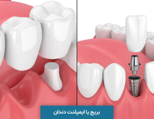 بریج یا ایمپلنت دندان