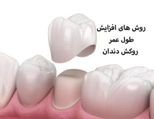 عمر روکش دندان