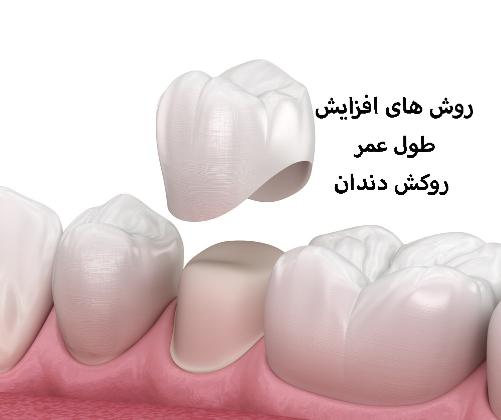 عمر روکش دندان