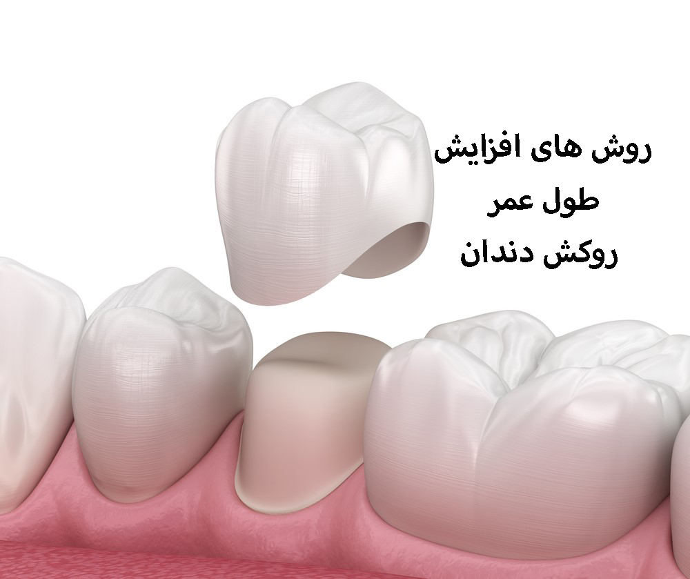 عمر روکش دندان