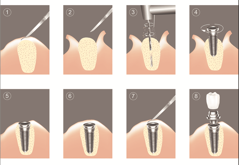 مراحل کاشت ایمپلنت دندان