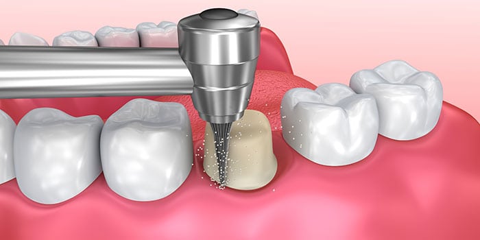 مراحل روکش کردن دندان