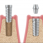 مراحل کاشت ایمپلنت دندان