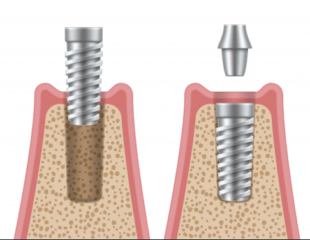 مراحل کاشت ایمپلنت دندان