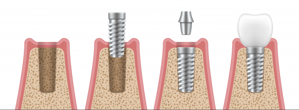 مراحل کاشت ایمپلنت دندان