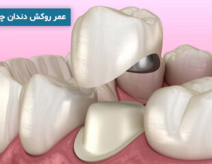 عمر روکش دندان