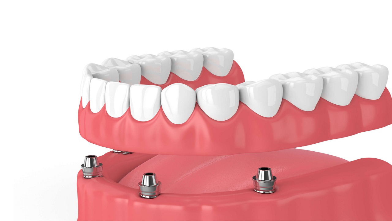 مراحل اوردنچر دندان