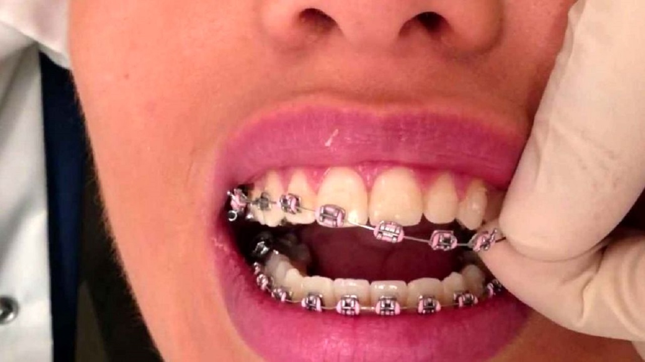 کشیدن دندان-ارتودنسی دندان