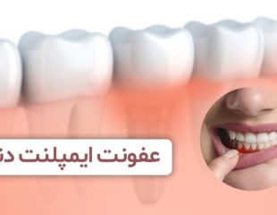 عفونت-ایمپلنت-دندان