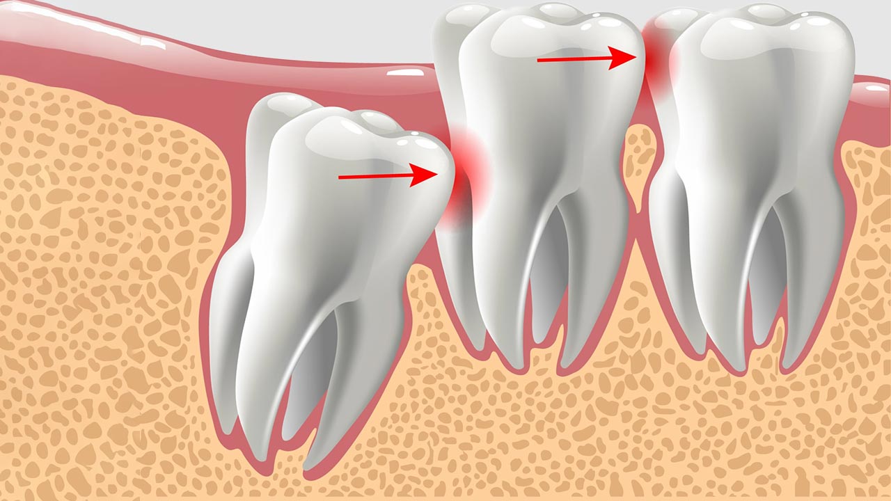 شرایط کشیدن دندان عقل