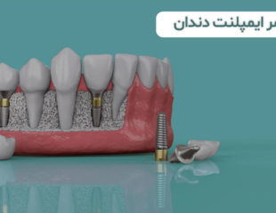طول-عمر-لمینت-دندان
