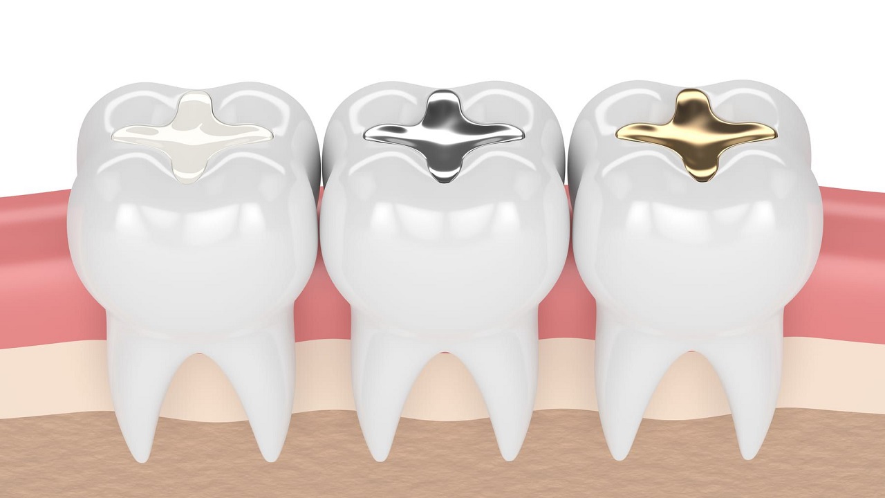 نوع ماده پر کننده دندان