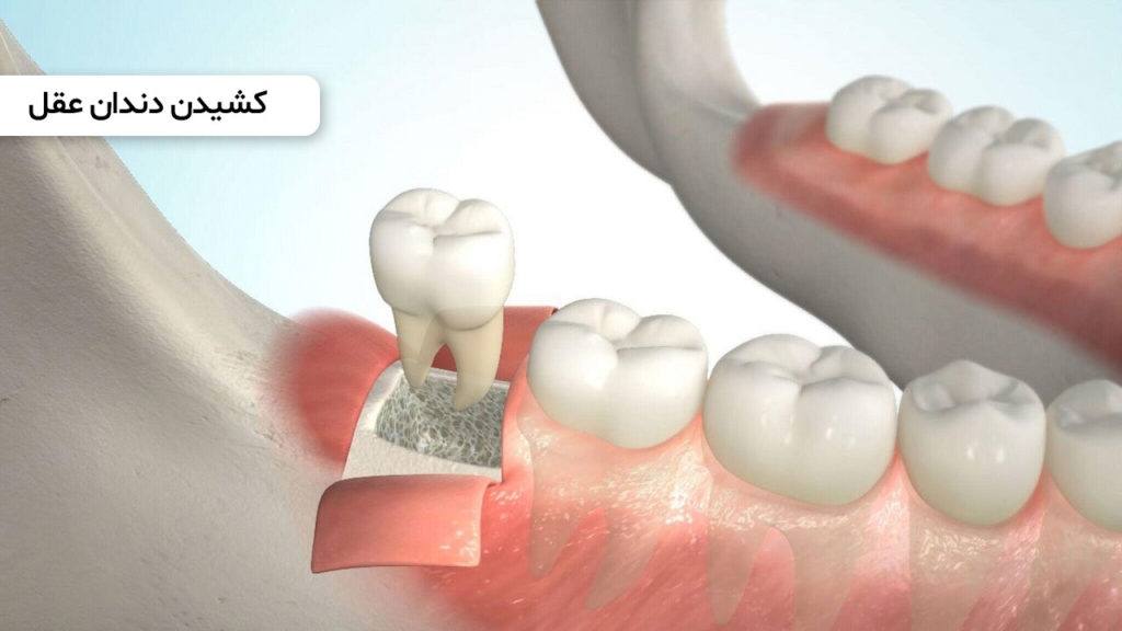 کشیدن دندان عقل