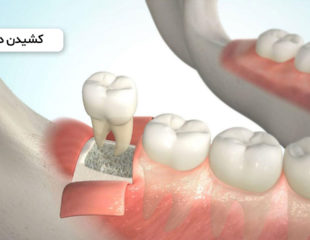 کشیدن دندان عقل