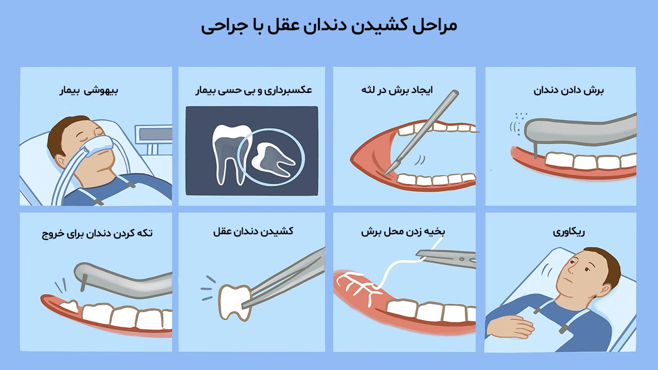 کشیدن دندان عقل با جراحی