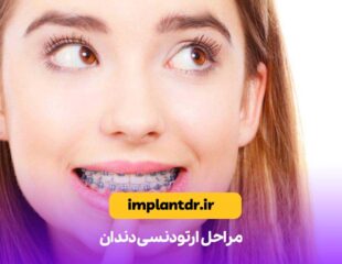 مراحل ارتودنسی دندان